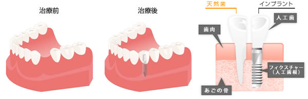 インプラントの仕組み