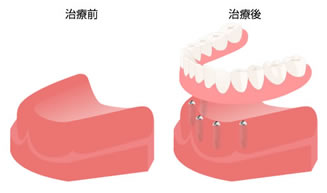 インプラントの仕組み